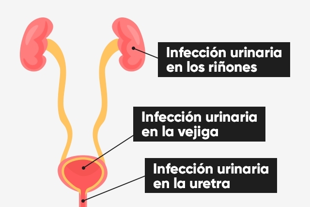 infección urinaria