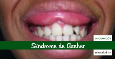 Síndrome de Ascher