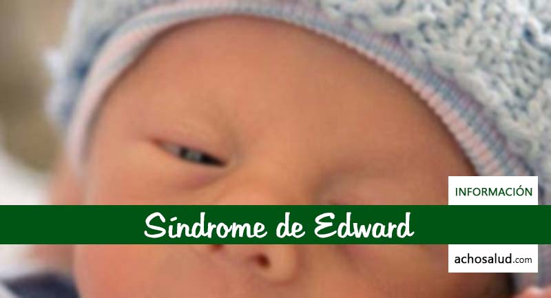 Síndrome de Edward