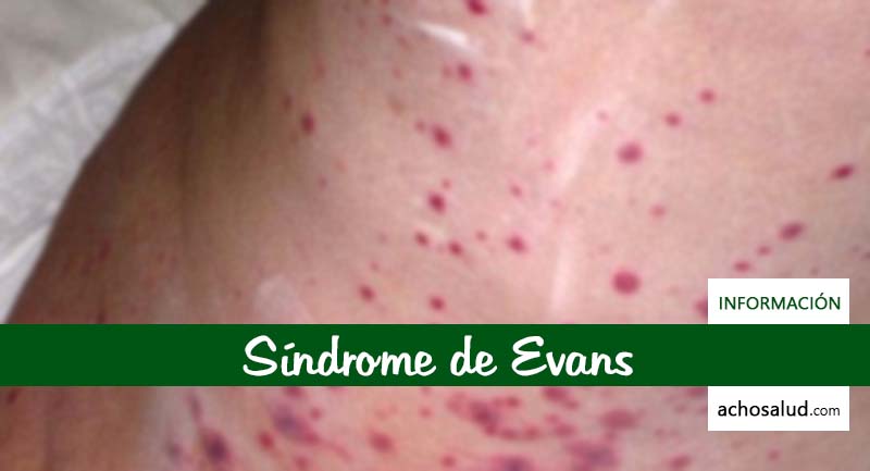 Síndrome de Evans