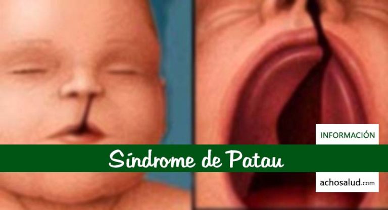 Síndrome de Patau: causas y efectos importantes