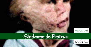 Síndrome de Proteus