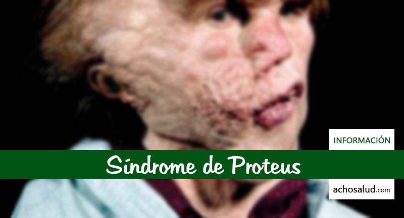 Síndrome de Proteus