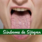 Síndrome de Sjögren