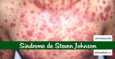 Síndrome de Steven Johnson