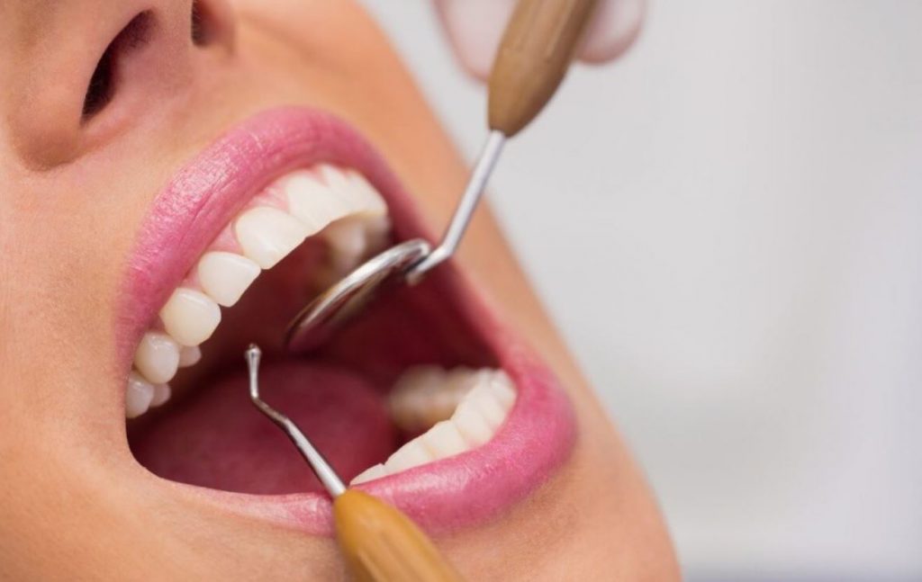 Como eliminar el sarro de los dientes