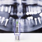 La importancia del material en los implantes dentales