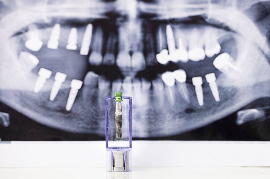 La importancia del material en los implantes dentales